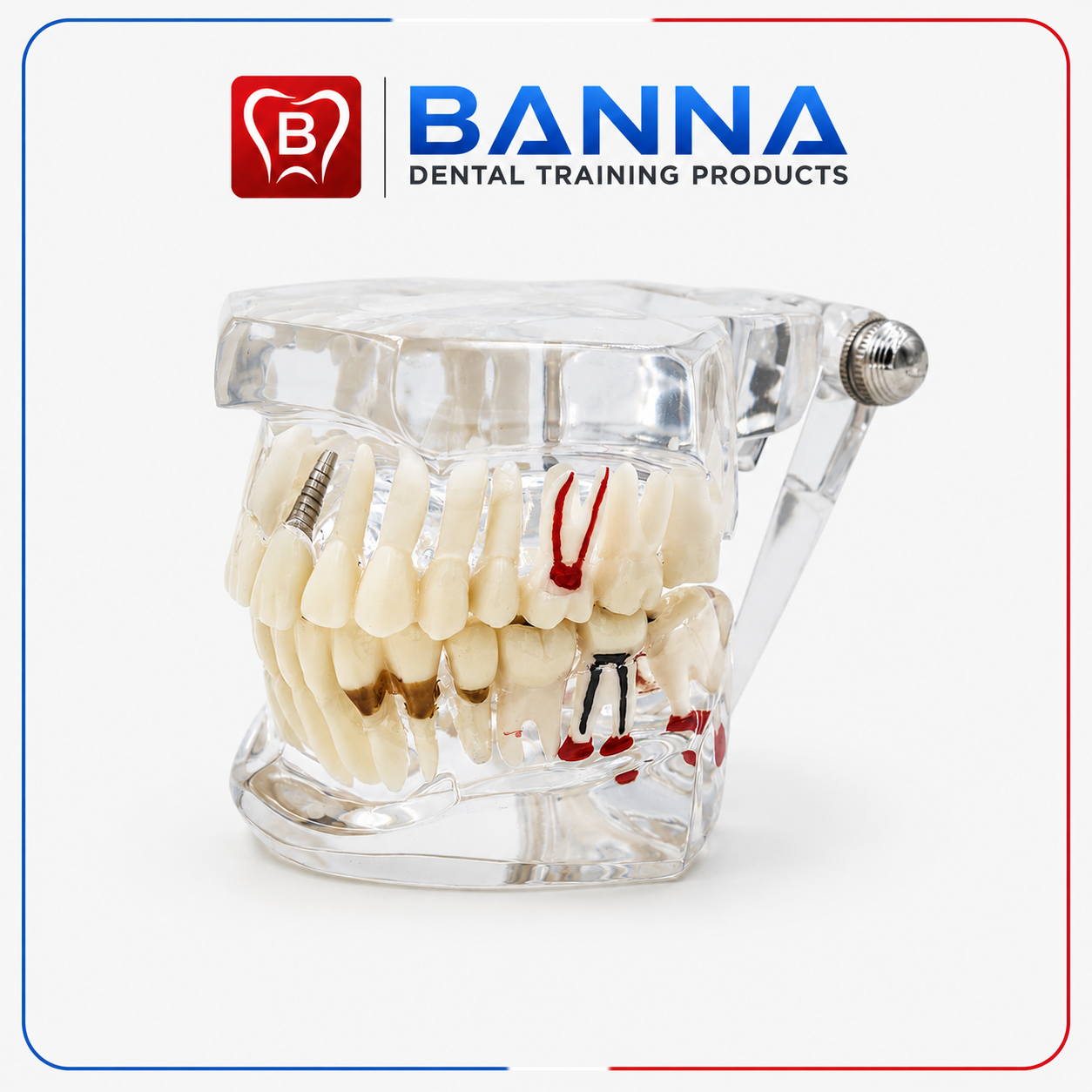 BANNA Transparent Dental Pathology Model